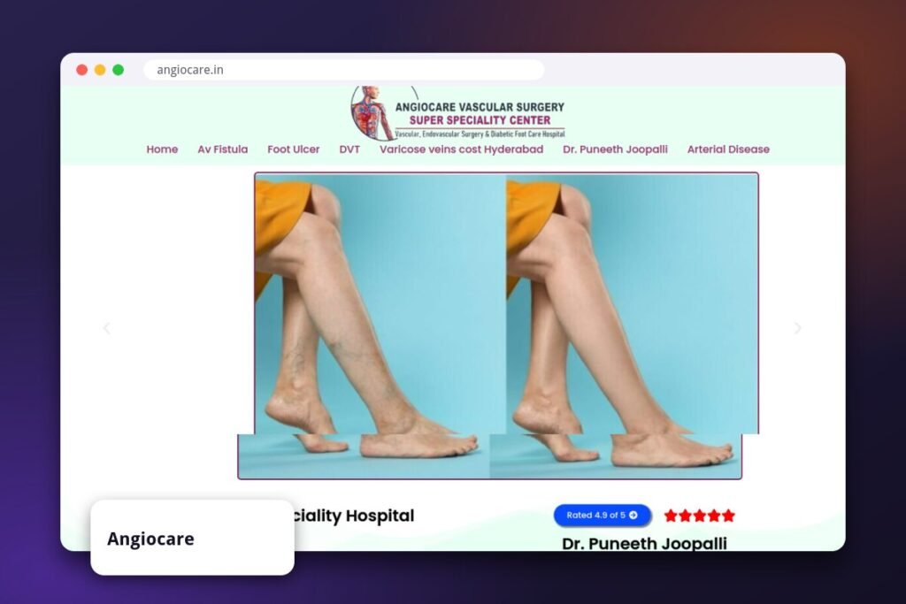 Angiocare vascular surgery hospital website shown in a browser